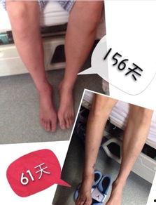 手术钢钉图片,精密医疗的坚强守护者